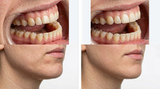 Bruxismus Botox: Vorher-Nachher, Kosten und Alternativen - Arando Gesundheitsmagazin